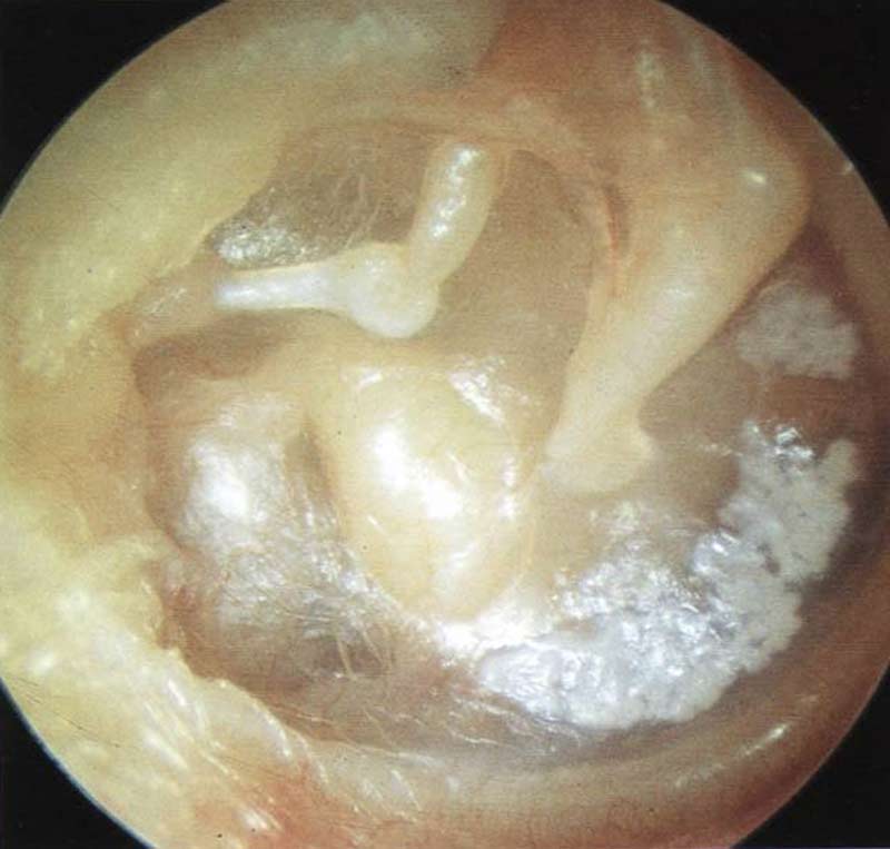 最新胆脂瘤手术价格及其变化，探索学习与自信的力量