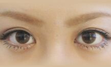 眼部整形新技术,重塑魅力双眸,自信闪耀登场