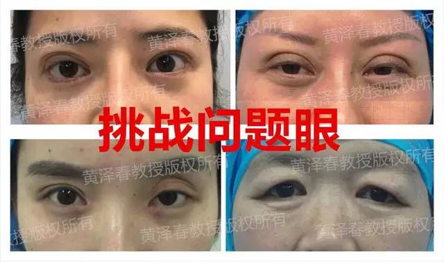 眼部整形新技术,重塑魅力双眸,自信闪耀登场