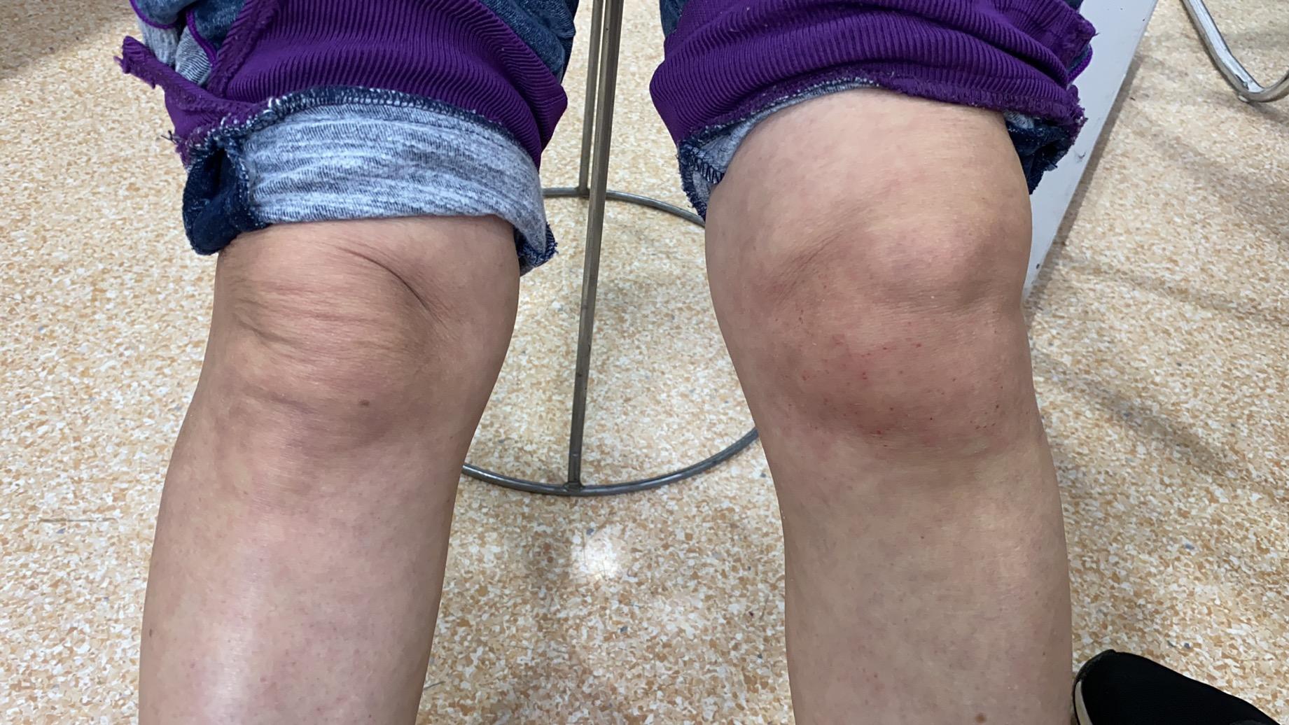 最新类风湿关节炎诊疗指南,科技引领健康未来,重塑生活品质