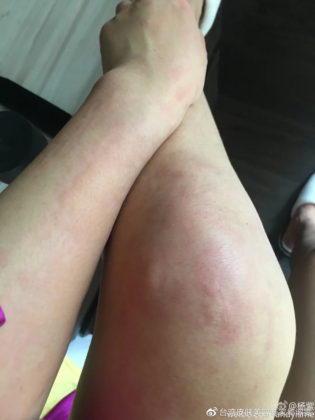 明星荨麻疹,明星荨麻疹，从星光熠熠到自我超越的励志之旅