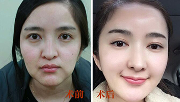 最新面部提升技术,最新面部提升技术，重塑青春的奇迹